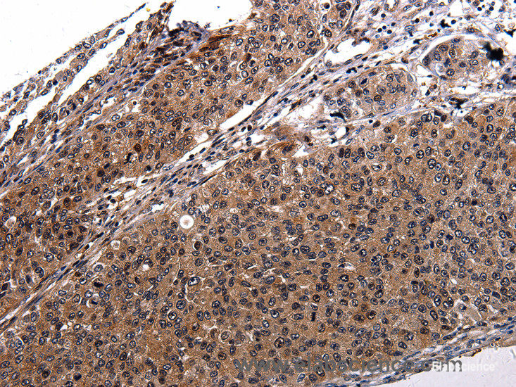 Immunohistochemistry of paraffin-embedded Human cervical cancer tissue using RAB41 Polyclonal Antibody at dilution 1:100