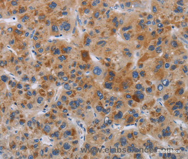 Immunohistochemistry of paraffin-embedded Human liver cancer tissue using IAPP Polyclonal Antibody at dilution 1:40