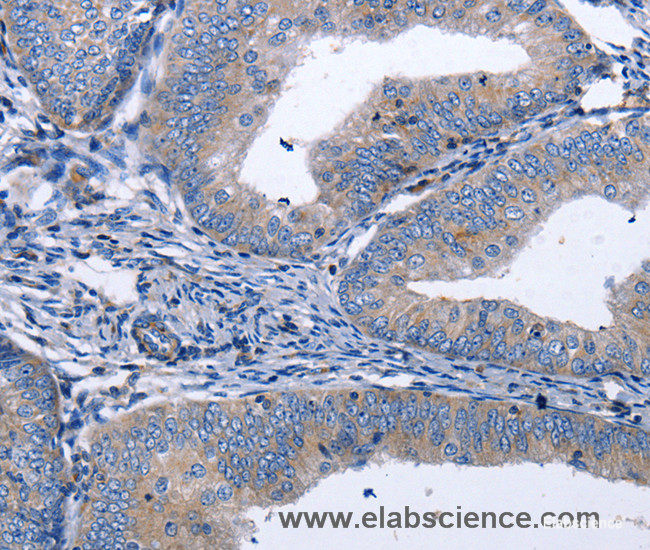 Immunohistochemistry of paraffin-embedded Human cervical cancer tissue using BDNF Polyclonal Antibody at dilution 1:40