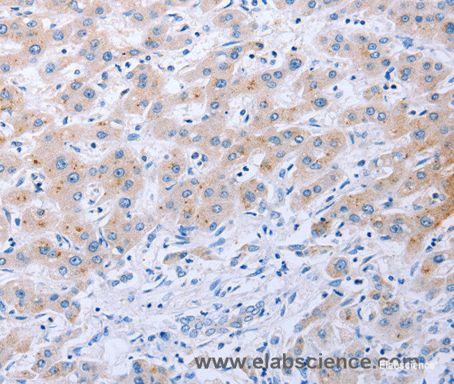 Immunohistochemistry of paraffin-embedded Human liver cancer tissue using FGF4 Polyclonal Antibody at dilution 1:40