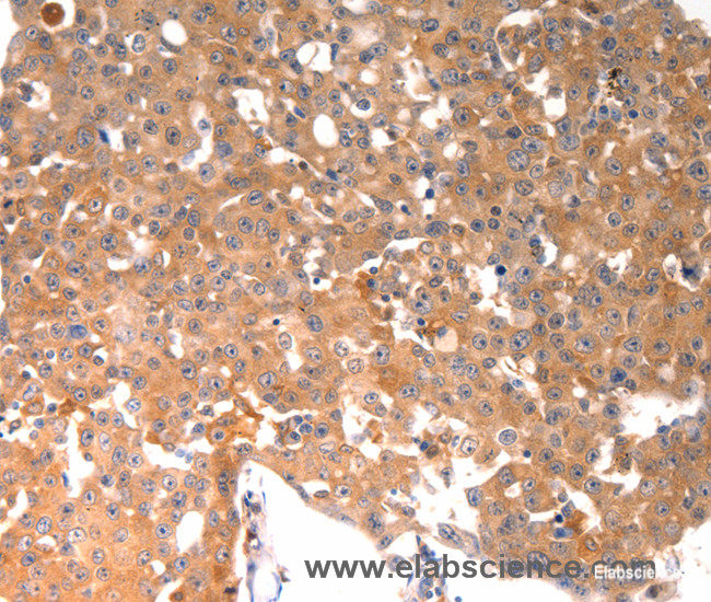 Immunohistochemistry of paraffin-embedded Human breast cancer tissue using BGLAP Polyclonal Antibody at dilution of 1:40