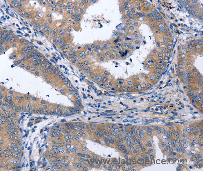 Immunohistochemistry of paraffin-embedded Human cervical cancer tissue using NPPB Polyclonal Antibody at dilution 1:40