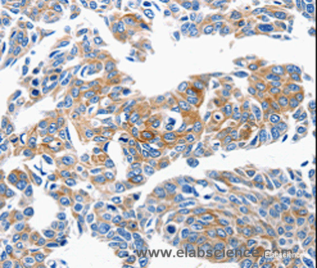 Immunohistochemistry of paraffin-embedded Human lung cancer tissue using CCL6 Polyclonal Antibody at dilution 1:50