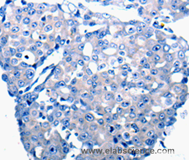 Immunohistochemistry of paraffin-embedded Human breast cancer tissue using CCL2 Polyclonal Antibody at dilution 1:50