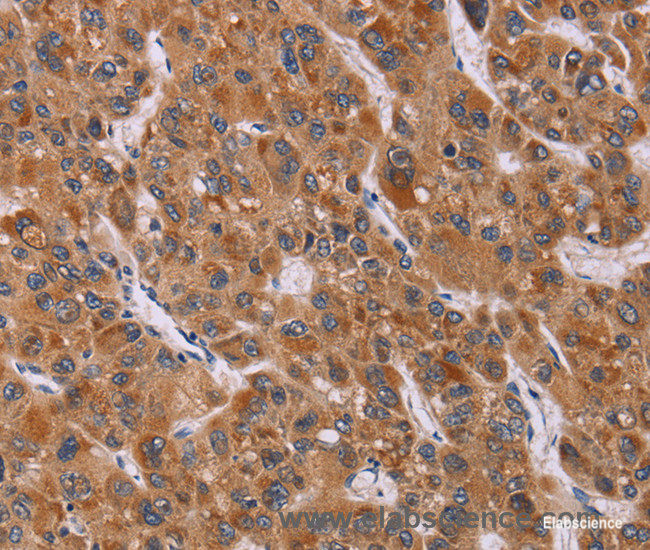 Immunohistochemistry of paraffin-embedded Human liver cancer tissue using CALCA Polyclonal Antibody at dilution 1:40