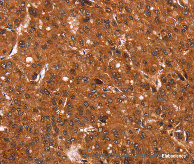 Immunohistochemistry of paraffin-embedded Human liver cancer tissue using Cyclin D3 Polyclonal Antibody at dilution 1:40
