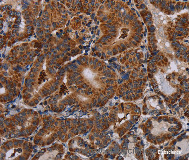 Immunohistochemistry of paraffin-embedded Human thyroid cancer tissue using DISC1 Polyclonal Antibody at dilution 1:30