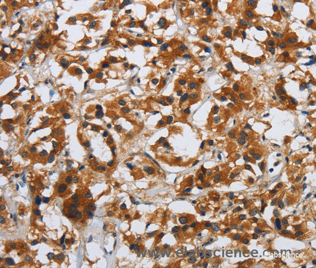 Immunohistochemistry of paraffin-embedded Human thyroid cancer tissue using DSP Polyclonal Antibody at dilution 1:40