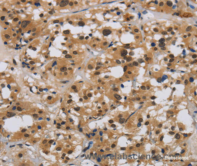 Immunohistochemistry of paraffin-embedded Human thyroid cancer tissue using E2F4 Polyclonal Antibody at dilution 1:40