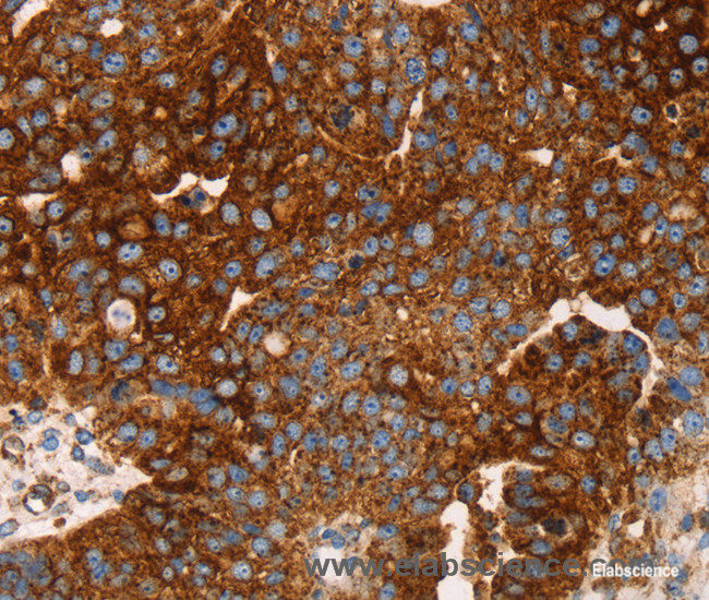 Immunohistochemistry of paraffin-embedded Human breast cancer tissue using EDAR Polyclonal Antibody at dilution 1:45