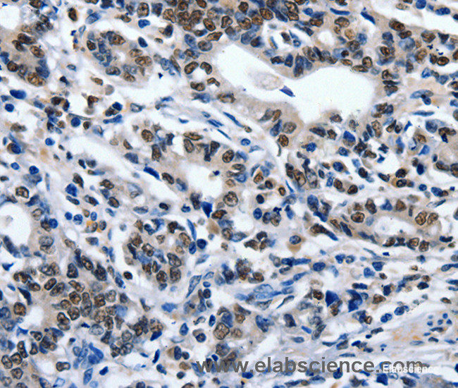 Immunohistochemistry of paraffin-embedded Human gasrtic cancer tissue using CD203c Polyclonal Antibody at dilution 1:80