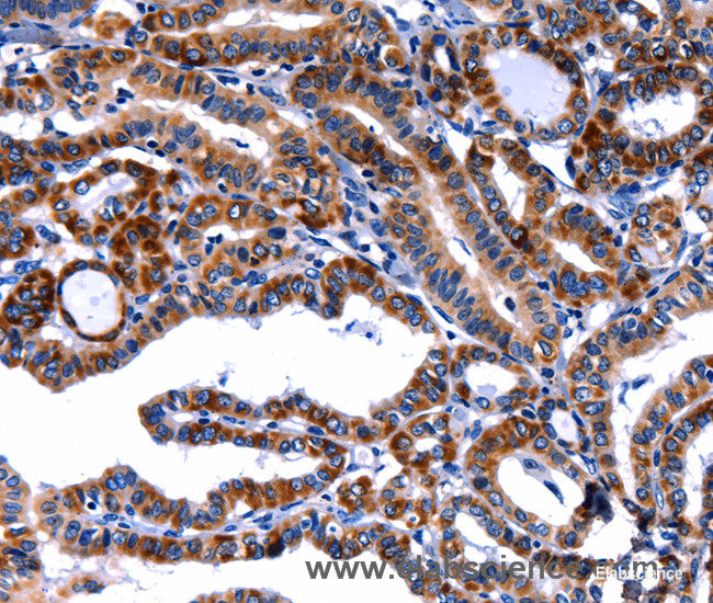 Immunohistochemistry of paraffin-embedded Human thyroid cancer tissue using FBN1 Polyclonal Antibody at dilution 1:40