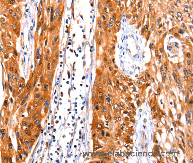 Immunohistochemistry of paraffin-embedded Human esophagus cancer tissue using FBLN1 Polyclonal Antibody at dilution 1:47