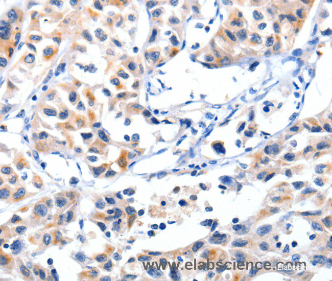 Immunohistochemistry of paraffin-embedded Human lung cancer tissue using Fibulin 5 Polyclonal Antibody at dilution 1:85