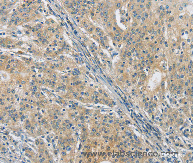 Immunohistochemistry of paraffin-embedded Human gasrtic cancer tissue using PKD1 Polyclonal Antibody at dilution 1:40