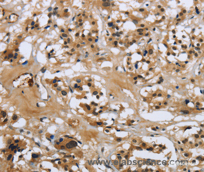 Immunohistochemistry of paraffin-embedded Human thyroid cancer tissue using LGALS7 Polyclonal Antibody at dilution 1:50