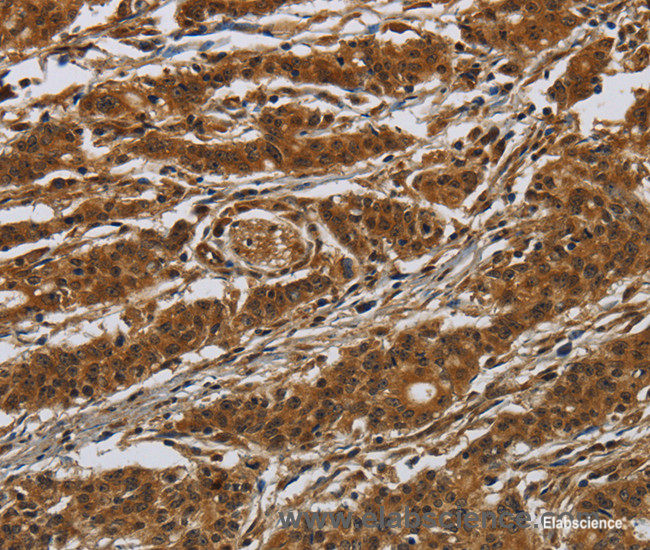 Immunohistochemistry of paraffin-embedded Human gasrtic cancer tissue using GATA5 Polyclonal Antibody at dilution 1:50