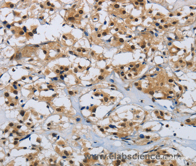 Immunohistochemistry of paraffin-embedded Human thyroid cancer tissue using CMTM8 Polyclonal Antibody at dilution 1:40