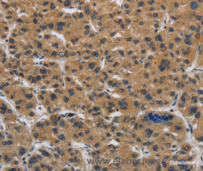 Immunohistochemistry of paraffin-embedded Human liver cancer tissue using Claudin 2 Polyclonal Antibody at dilution 1:50