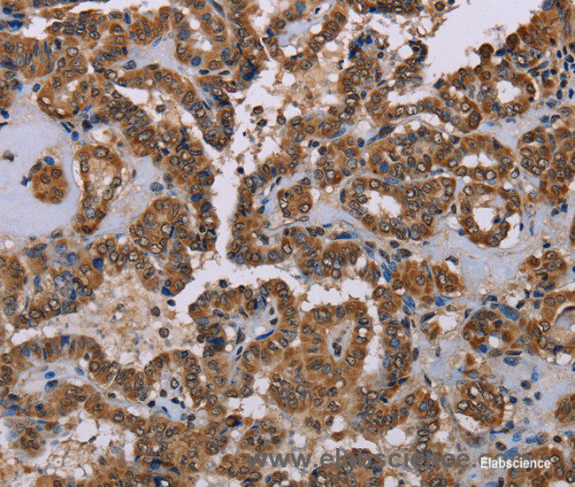 Immunohistochemistry of paraffin-embedded Human thyroid cancer tissue using GRK1 Polyclonal Antibody at dilution 1:40