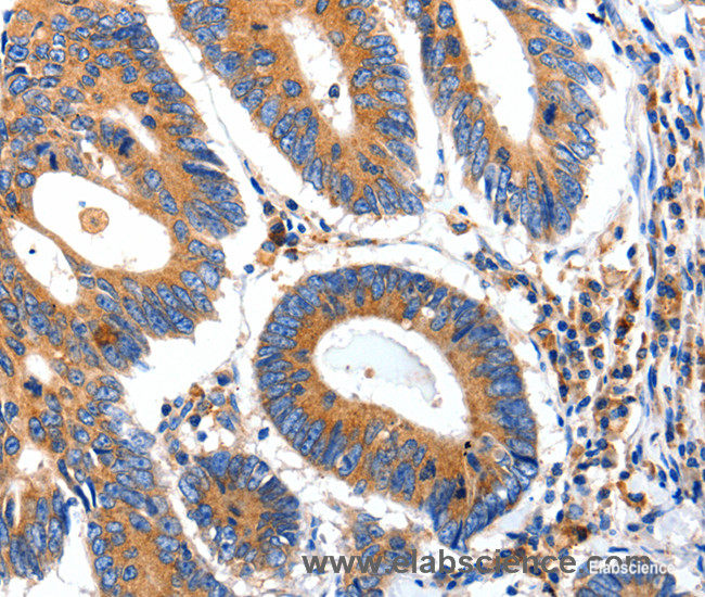 Immunohistochemistry of paraffin-embedded Human colon cancer tissue using IGFBP7 Polyclonal Antibody at dilution 1:50