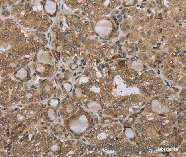 Immunohistochemistry of paraffin-embedded Human thyroid cancer tissue using STMN2/3/4 Polyclonal Antibody at dilution 1:45