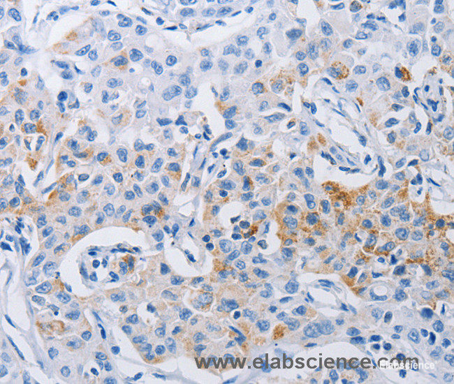 Immunohistochemistry of paraffin-embedded Human lung cancer tissue using LRIG1 Polyclonal Antibody at dilution 1:120
