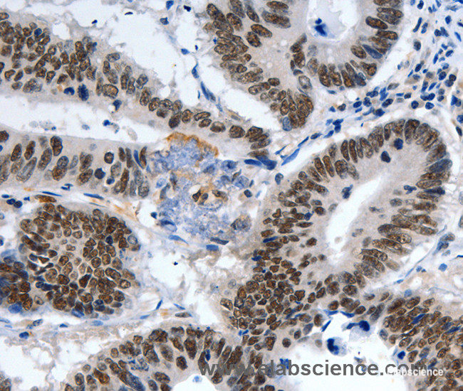 Immunohistochemistry of paraffin-embedded Human colon cancer tissue using LRP5 Polyclonal Antibody at dilution 1:55