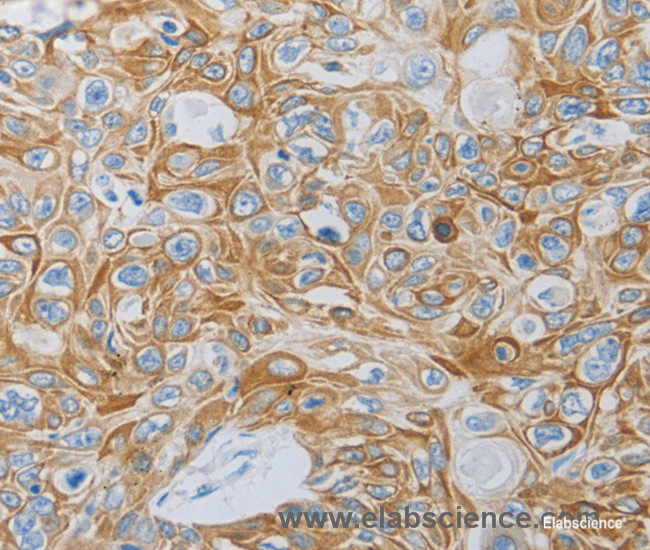 Immunohistochemistry of paraffin-embedded Human esophagus cancer tissue using MC5R Polyclonal Antibody at dilution 1:60