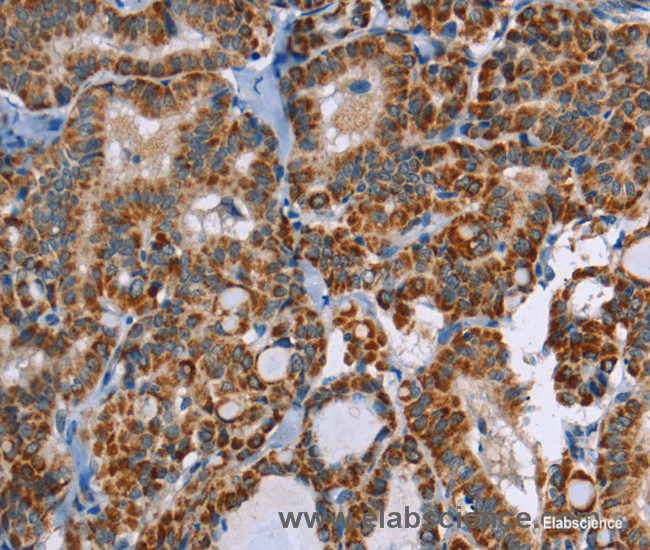 Immunohistochemistry of paraffin-embedded Human thyroid cancer tissue using ABCB1 Polyclonal Antibody at dilution 1:30