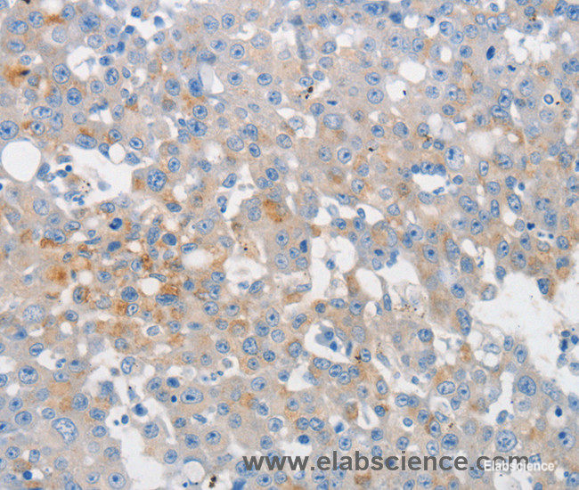 Immunohistochemistry of paraffin-embedded Human breast cancer tissue using MUC5AC Polyclonal Antibody at dilution 1:80