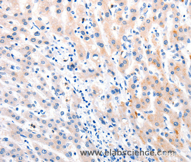 Immunohistochemistry of paraffin-embedded Human liver cancer tissue using MTOR Polyclonal Antibody at dilution 1:60