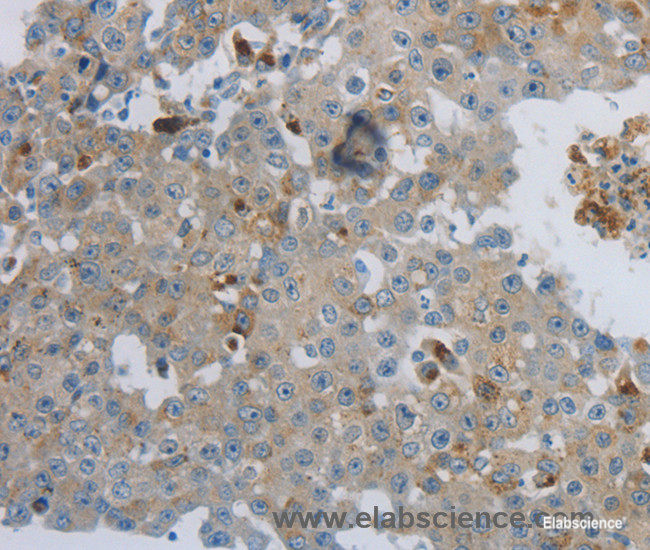 Immunohistochemistry of paraffin-embedded Human breast cancer tissue using CKMT1A Polyclonal Antibody at dilution 1:100