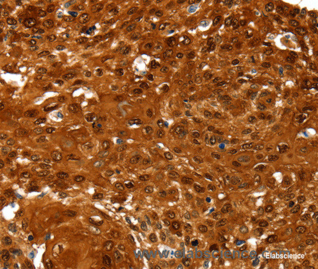 Immunohistochemistry of paraffin-embedded Human cervical cancer tissue using NCOR1 Polyclonal Antibody at dilution 1:60