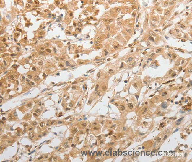 Immunohistochemistry of paraffin-embedded Human lung cancer tissue using GRIN2C Polyclonal Antibody at dilution 1:100