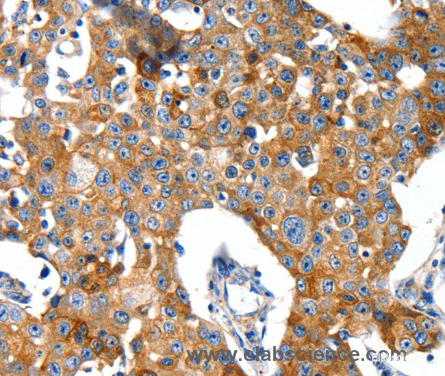 Immunohistochemistry of paraffin-embedded Human breast cancer tissue using GluR2 Polyclonal Antibody at dilution 1:40