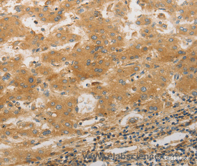 Immunohistochemistry of paraffin-embedded Human liver cancer tissue using PLPP1 Polyclonal Antibody at dilution 1:50