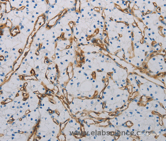 Immunohistochemistry of paraffin-embedded Human renal cancer tissue using CD31 Polyclonal Antibody at dilution 1:40