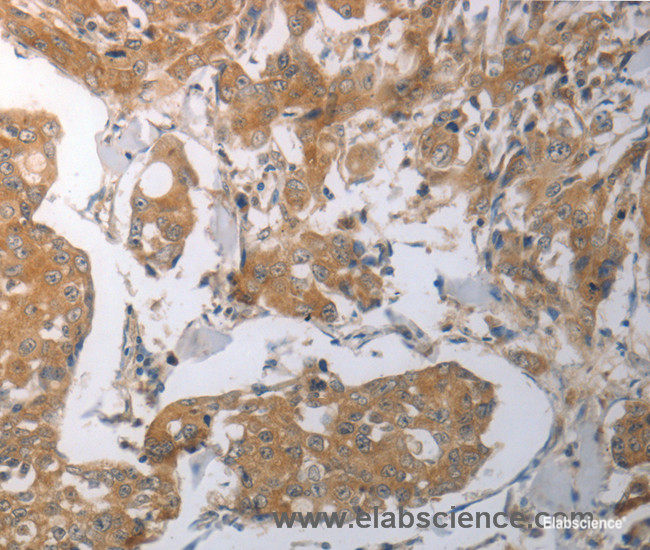 Immunohistochemistry of paraffin-embedded Human breast cancer tissue using SHH Polyclonal Antibody at dilution 1:70