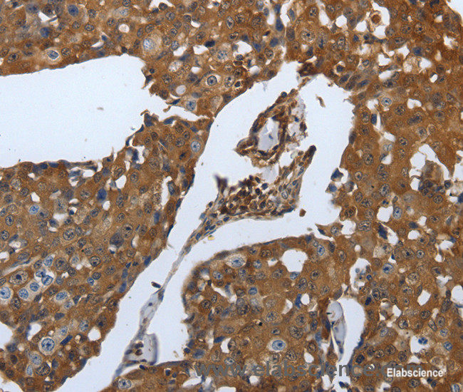 Immunohistochemistry of paraffin-embedded Human breast cancer tissue using SLC34A2 Polyclonal Antibody at dilution of 1:70