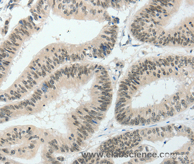 Immunohistochemistry of paraffin-embedded Human colon cancer tissue using HNF1B Polyclonal Antibody at dilution 1:80
