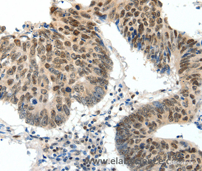Immunohistochemistry of paraffin-embedded Human colon cancer tissue using TOP2A Polyclonal Antibody at dilution 1:30