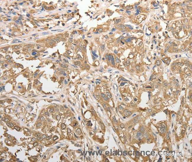 Immunohistochemistry of paraffin-embedded Human esophagus cancer tissue using ADHFE1 Polyclonal Antibody at dilution 1:50