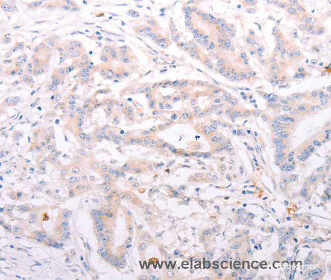 Immunohistochemistry of paraffin-embedded Human colon cancer tissue using ANKRA2 Polyclonal Antibody at dilution 1:50