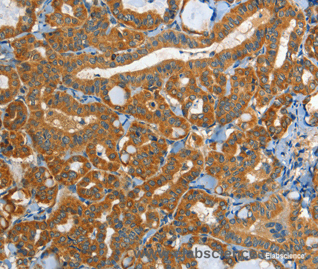 Immunohistochemistry of paraffin-embedded Human thyroid cancer tissue using EPHB3 Polyclonal Antibody at dilution 1:40