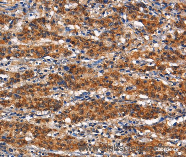 Immunohistochemistry of paraffin-embedded Human gasrtic cancer tissue using CD13 Polyclonal Antibody at dilution 1:80