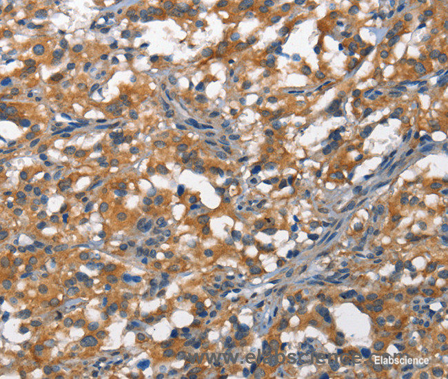 Immunohistochemistry of paraffin-embedded Human thyroid cancer tissue using DDR2 Polyclonal Antibody at dilution 1:40