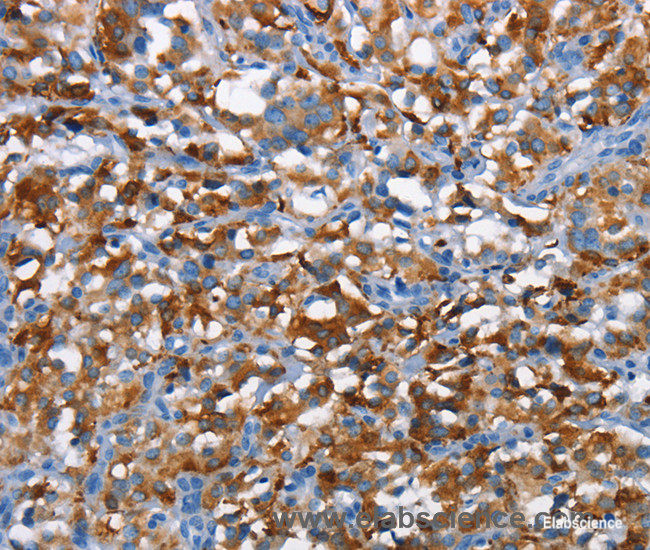 Immunohistochemistry of paraffin-embedded Human thyroid cancer tissue using CD226 Polyclonal Antibody at dilution 1:60