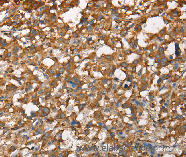 Immunohistochemistry of paraffin-embedded Human thyroid cancer tissue using CDC25A Polyclonal Antibody at dilution 1:60