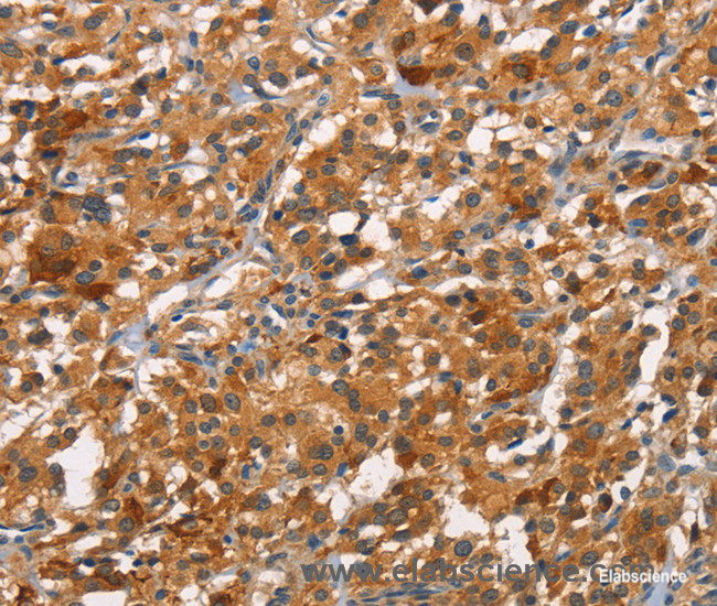 Immunohistochemistry of paraffin-embedded Human thyroid cancer tissue using CDC25B Polyclonal Antibody at dilution 1:45